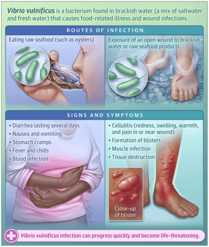 this could save your life: what you need to know about vibrio ...